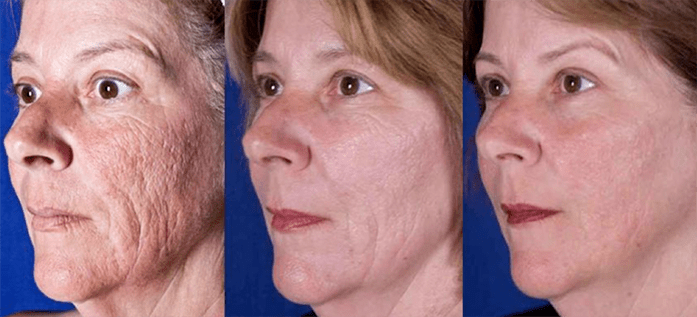 Hasil setelah prosedur peremajaan kulit wajah dengan laser
